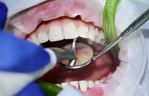 img-gum
