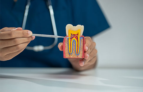 img-root_canal